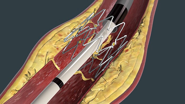 MRI scan image IVUS