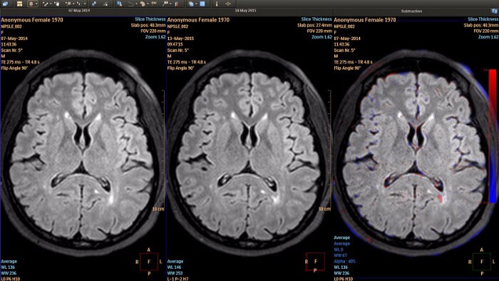MR Longitudinal Brain Imaging (LoBI)