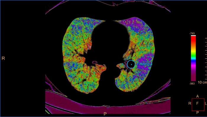CT Pulmonary Artery Analysis - CB kleuren overzicht