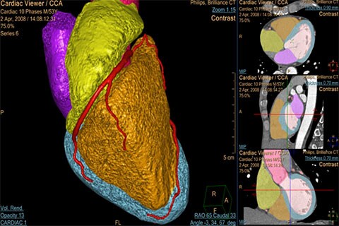 ct comprehensive cardiac analysis clinical image