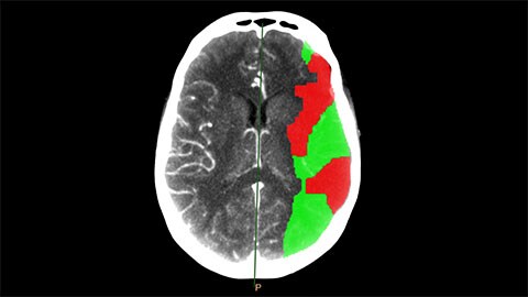 ct brain perfusion clinical image