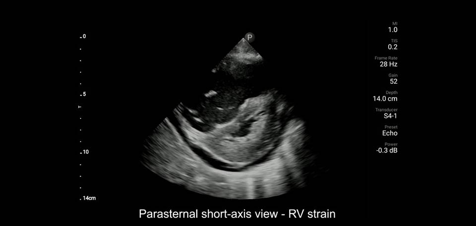 weergave van parasternale korte as - rv-strain