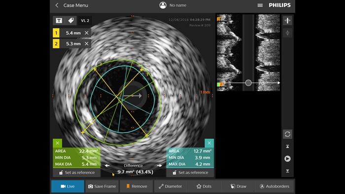 Philips beeldvormingsmodaliteit Intravascular Ultrasound