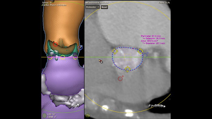 Klinisch beeld Philips HeartNavigator