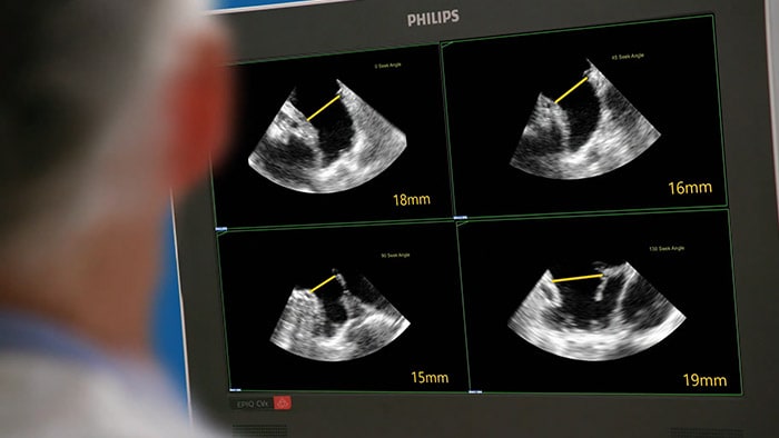 EPIQ CVxi interventioneel echografiesysteem