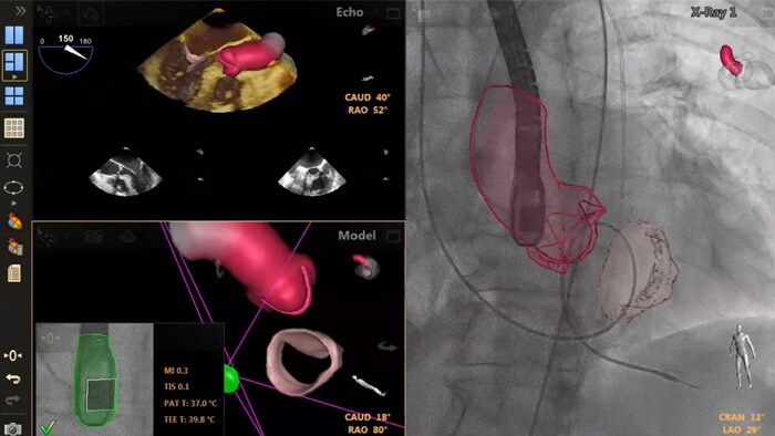 Transseptale punctiegeleiding