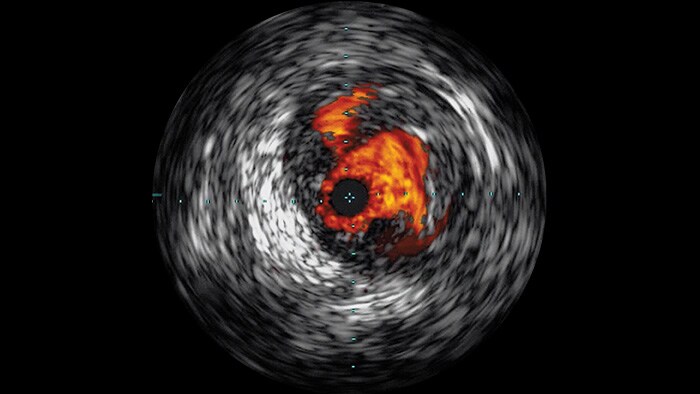 Intravasculaire echografie