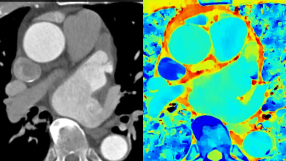Klinisch beeld van conventionele CT in vergelijking met klinisch beeld van spectrale-detector-CT