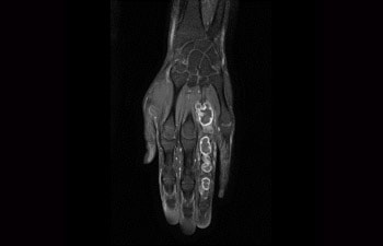 Hand/pols met tumor
