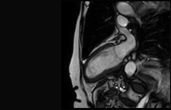 Acuut myocardiaal