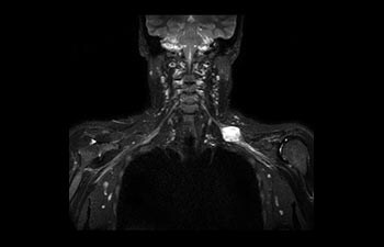 Plexus brachialis