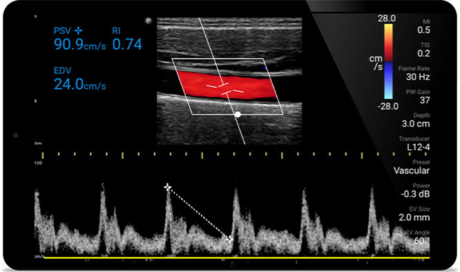 Afbeelding echografie vroegtijdige detectie