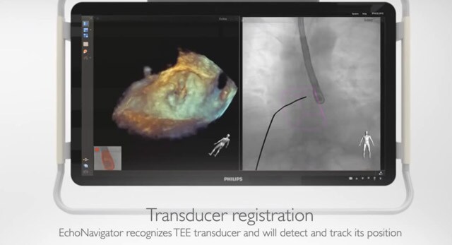 Echo Navigator fusing live X-ray and 3D ultrasound guidance for SHD-repair
