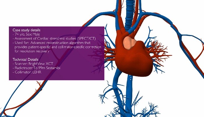 Advanced SPECT reconstruction algorithm