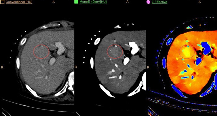 Webinar over Spectrale CT