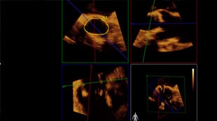  Live 3D TEE wordt in realtime weergegeven op het EchoNavigator-scherm