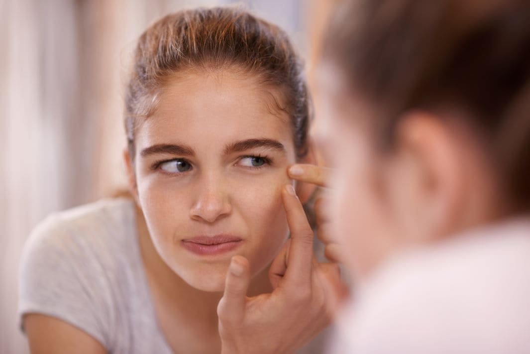 Wat niet te eten en drinken als u last hebt van acne
