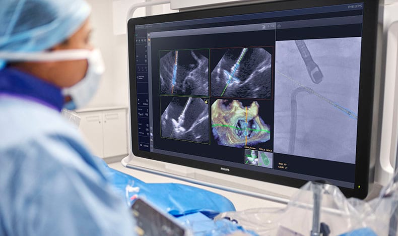Physician using EchoNavigator 5