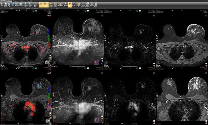 DynaCAD Breast Current Prior Layout (opent in een nieuw tabblad)