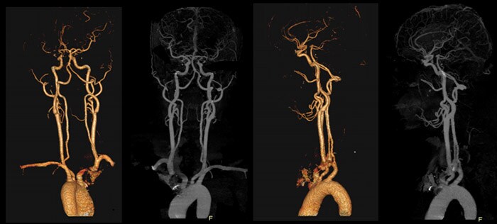 Download image (.jpg) Precise Suite Incisive carotid (opent in een nieuw tabblad)