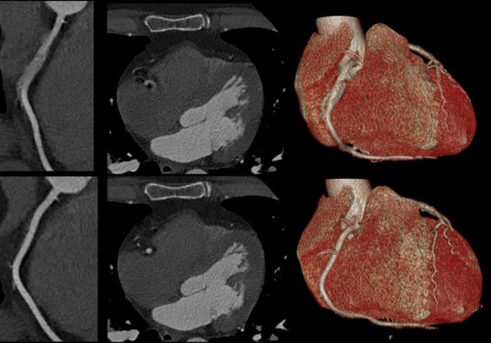 Download image (.jpg) Spectral CT 7500 Motion in Right Coronary Artery Comparison (opent in een nieuw tabblad)