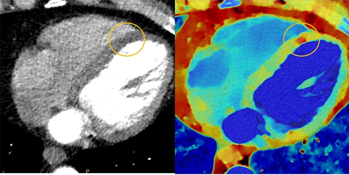 Download image (.jpg) Spectral CT 7500 Myocardial Perfusion Comparison (opent in een nieuw tabblad)