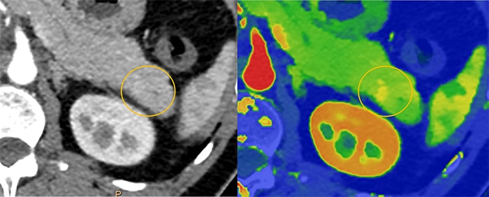 Download image (.jpg) Spectral CT 7500 Pancreatic Lesion Comparison (opent in een nieuw tabblad)