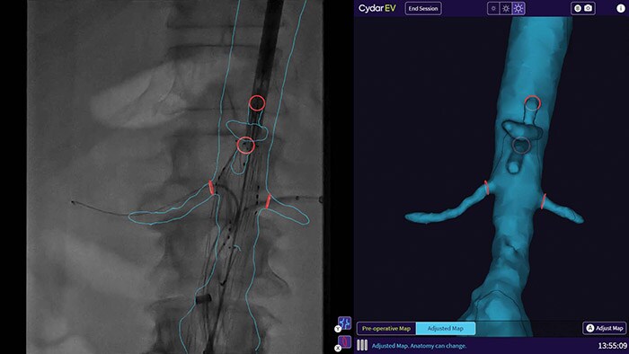 Philips integreert nieuwe AI en 3D technologie in zijn mobiele C-bogen (Zenition) om de workflow en behandelingen te verbeteren