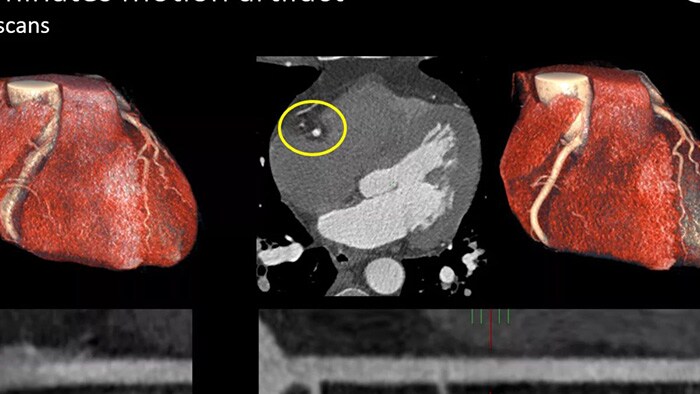 Spectraal CT beeld van hart  -  