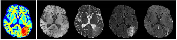 Brain MRI synthesis